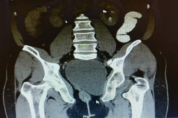 Rare tailgut cyst extended from pelvis to thigh successfully removed by KIMS doctors