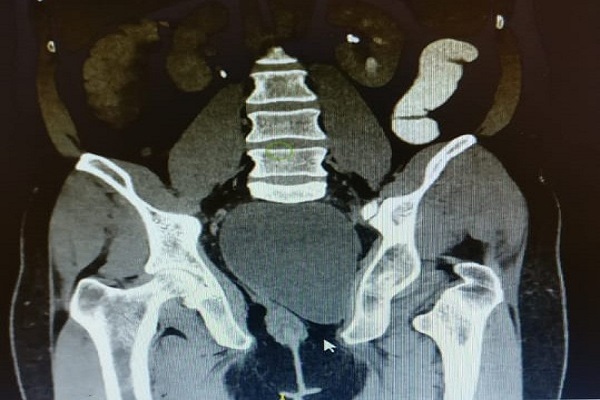 Rare tailgut cyst extended from pelvis to thigh successfully removed by KIMS doctors